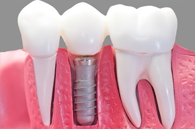 Có nên nhổ răng cấm bị sâu hay không?