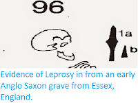 http://sciencythoughts.blogspot.co.uk/2015/05/evidence-of-leprosy-in-from-early-anglo.html