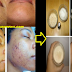 How To Get Rid Of Black Spots On Your Face Safe And Fast