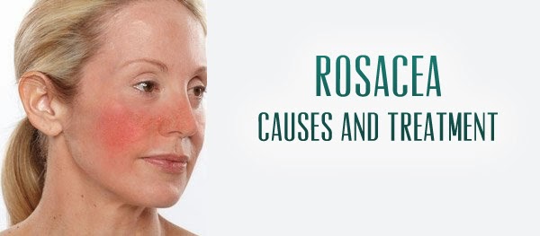 Rosacea Treatments Diagnosis Causes Symptoms Prevention Natural