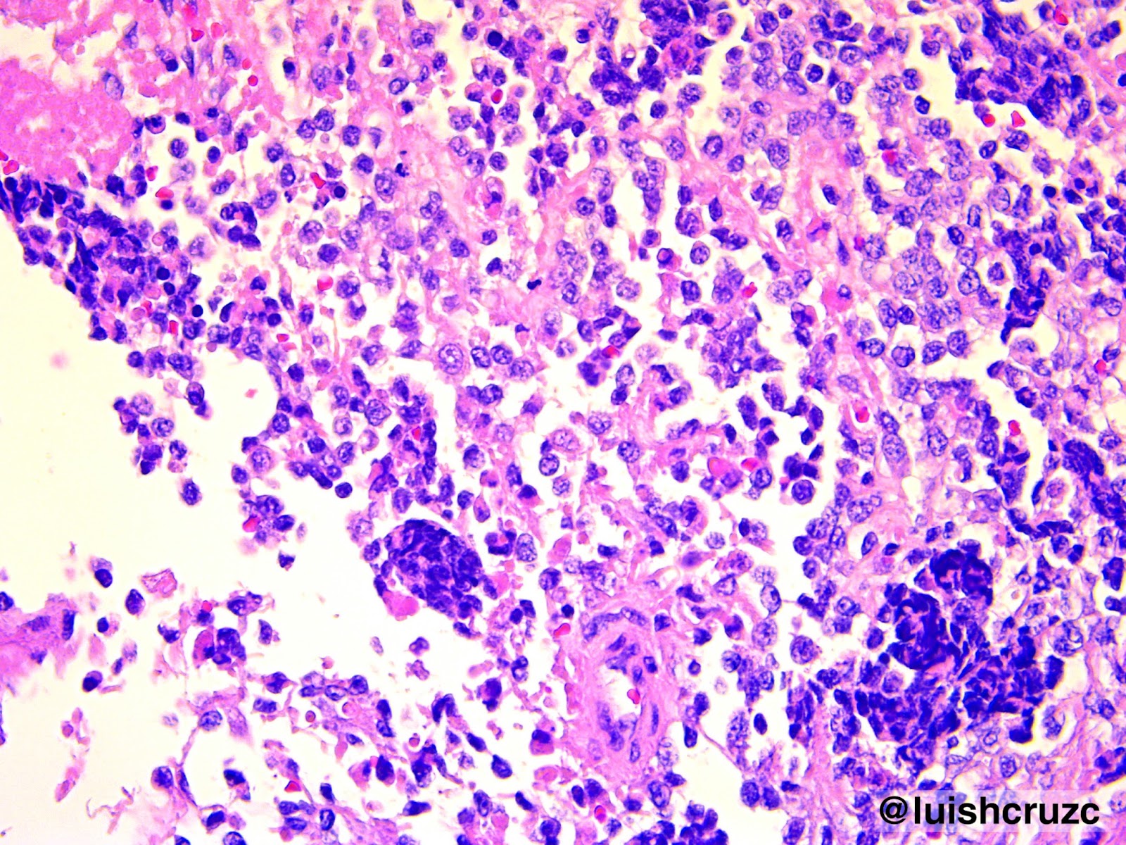 Patología CC: Rabdomiosarcoma alveolar / Alveolar Rhabdomyosarcoma