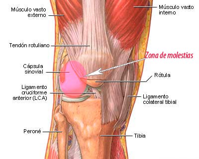 Ejercicios para fortalecer cuadriceps condromalacia rotuliana