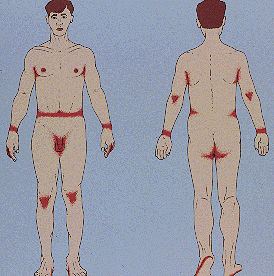 scabies burrow marks