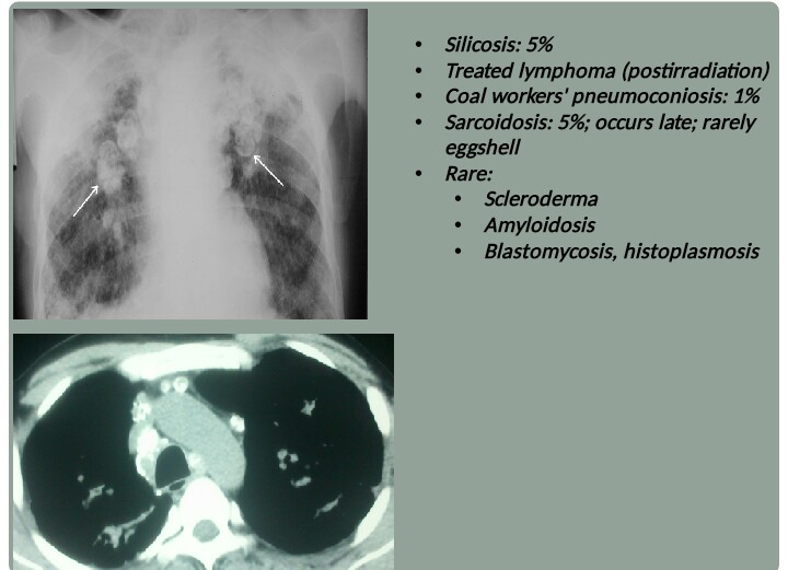 Chest Medicine Made EasyDr Deepu Egg Shell Calcification
