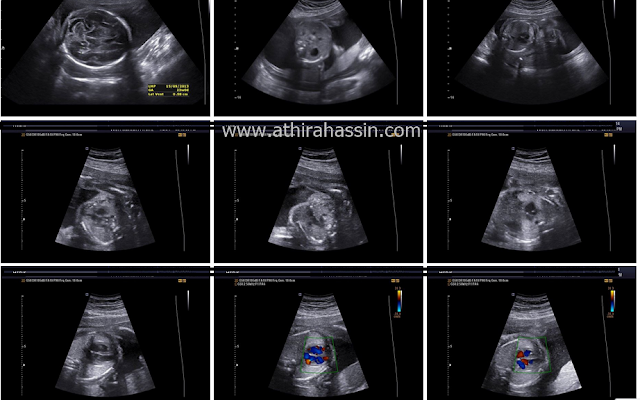 Beza Scan Baby 2d 3d 4d 5d Dan Hd Athirahassin