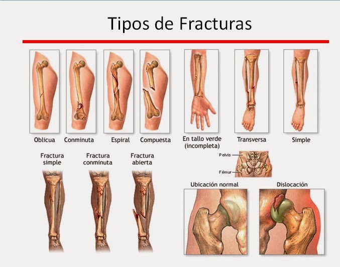 Traumatologia y Ortopedia: GENERALIDADES DE FRACTURAS