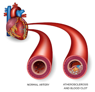 heart attack causes symptoms hindi | हार्ट अटैक की वजह