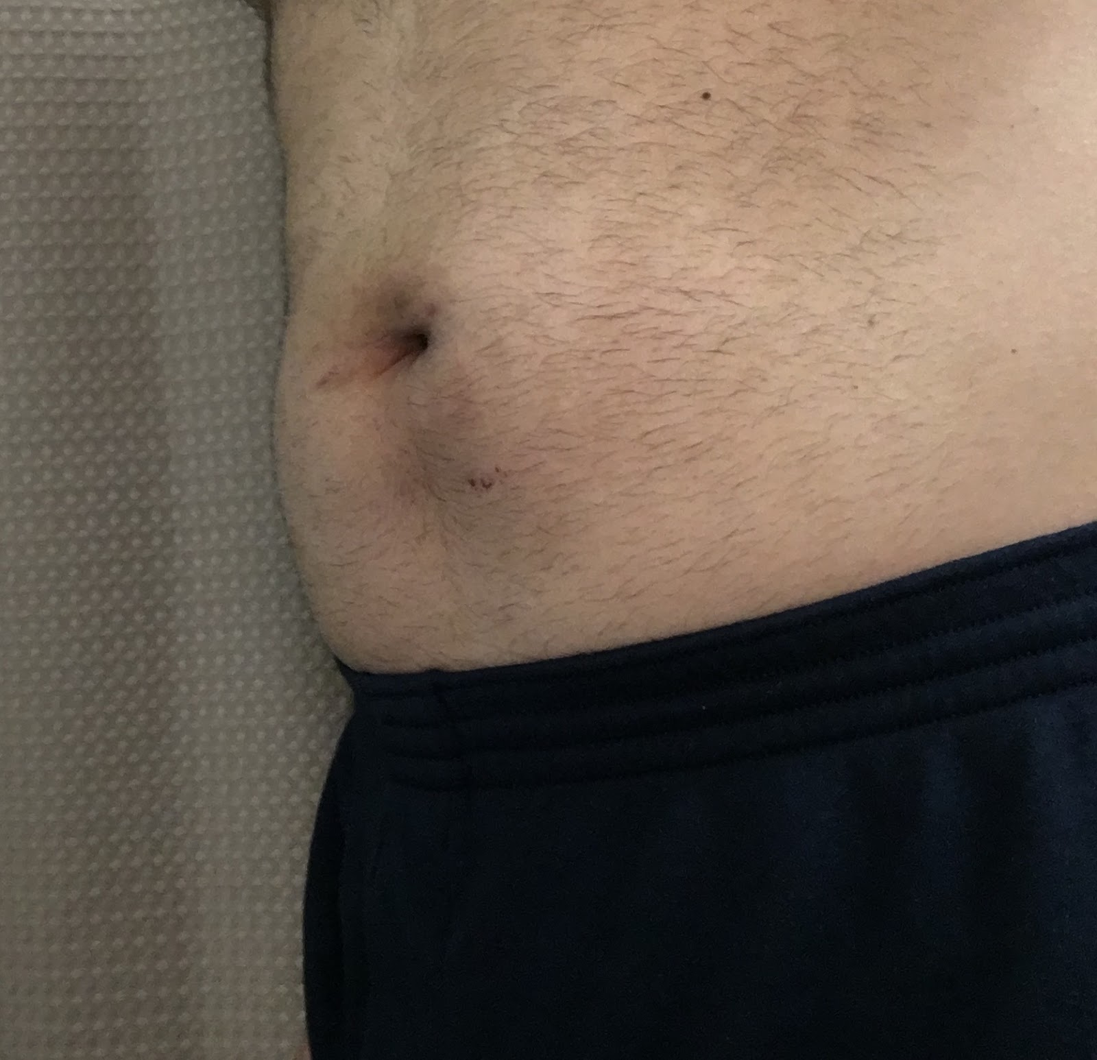 My hernia repair at Shouldice Hospital