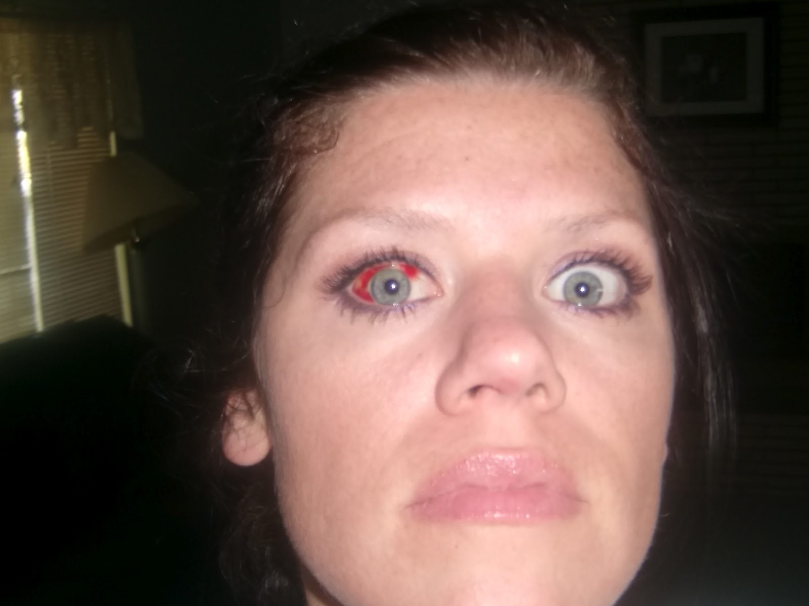 How To Get Rid Of A Popped Vessel In Your Eye