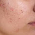 how to get ride of acne scars