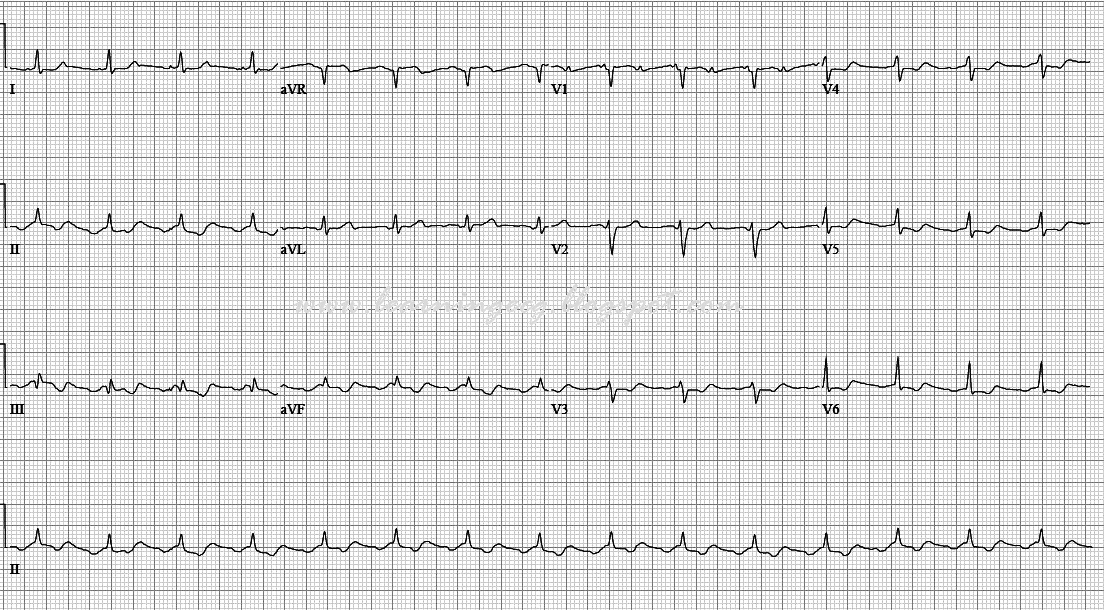 typical atrial flutter and ecg typical atrial flutter and ecg