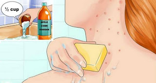 Put Apple Cider Vinegar on Your Face And See What Happens to Toxins, Eczema and Age Spots