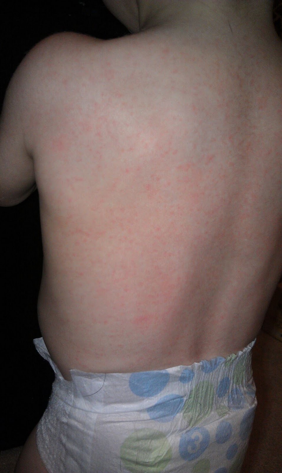 Lone Sunflower Utterly Confused with Food Allergies