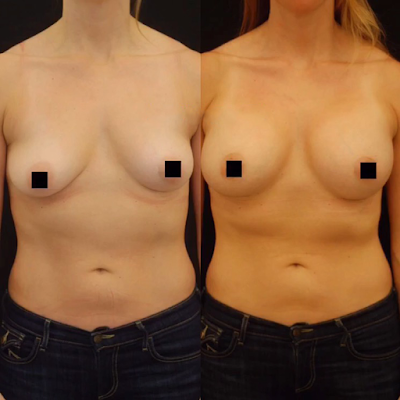Antes e Depois Mamoplastia de Aumento Antes e Depois Mamoplastia de Aumento