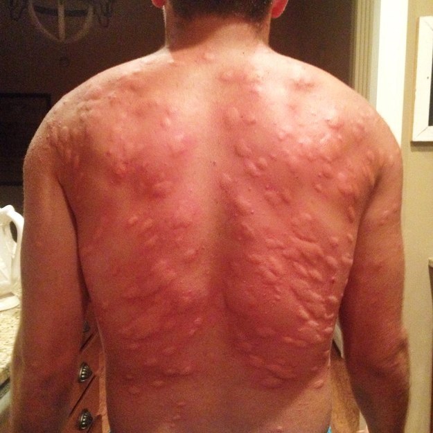how to get rid of bed bugs bites marks & itching - best beauty and how to get rid of bed bugs bites marks & itching - best beauty and
