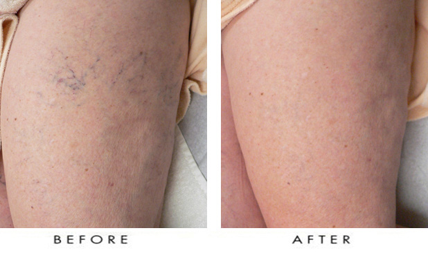 what is sclerotherapy