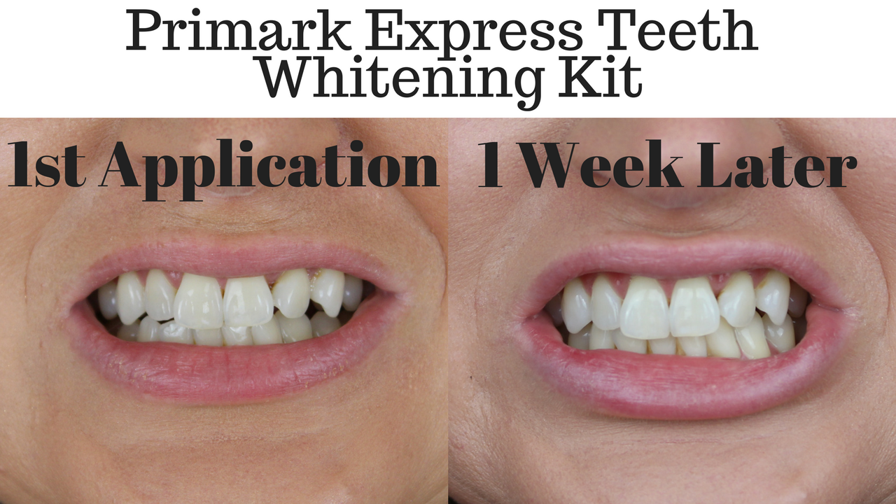 Primark Teeth Whitening Kit Review Does It Really Work Pink I Love The Fact That Primark Is Now Doing Teeth Whitening Kits Are Peroxide Free And Ridiculously Affordable However For Price Wasn T Expecting