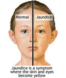 jaundice hepatitis skin yellowing vs difference eye face between homeopathy treatment disease but specialty center sclera