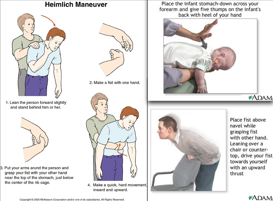 steps for the heimlich maneuver ｜ Matt's blog