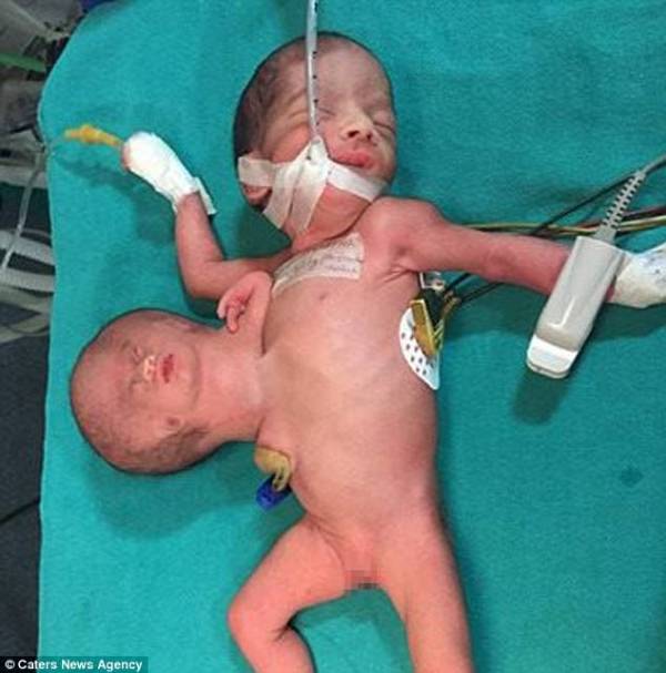 Kepala Bayi Kedua Tumbuh Diperut, Tak Disangka Saat Di Bedah Yang Terjadi Mengejutkan! Kepala Bayi Kedua Tumbuh Diperut, Tak Disangka Saat Di Bedah Yang Terjadi Mengejutkan!