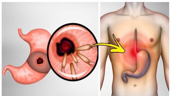 This Bacterium Causes Heartburn And Bloating, Here's How To Remove It