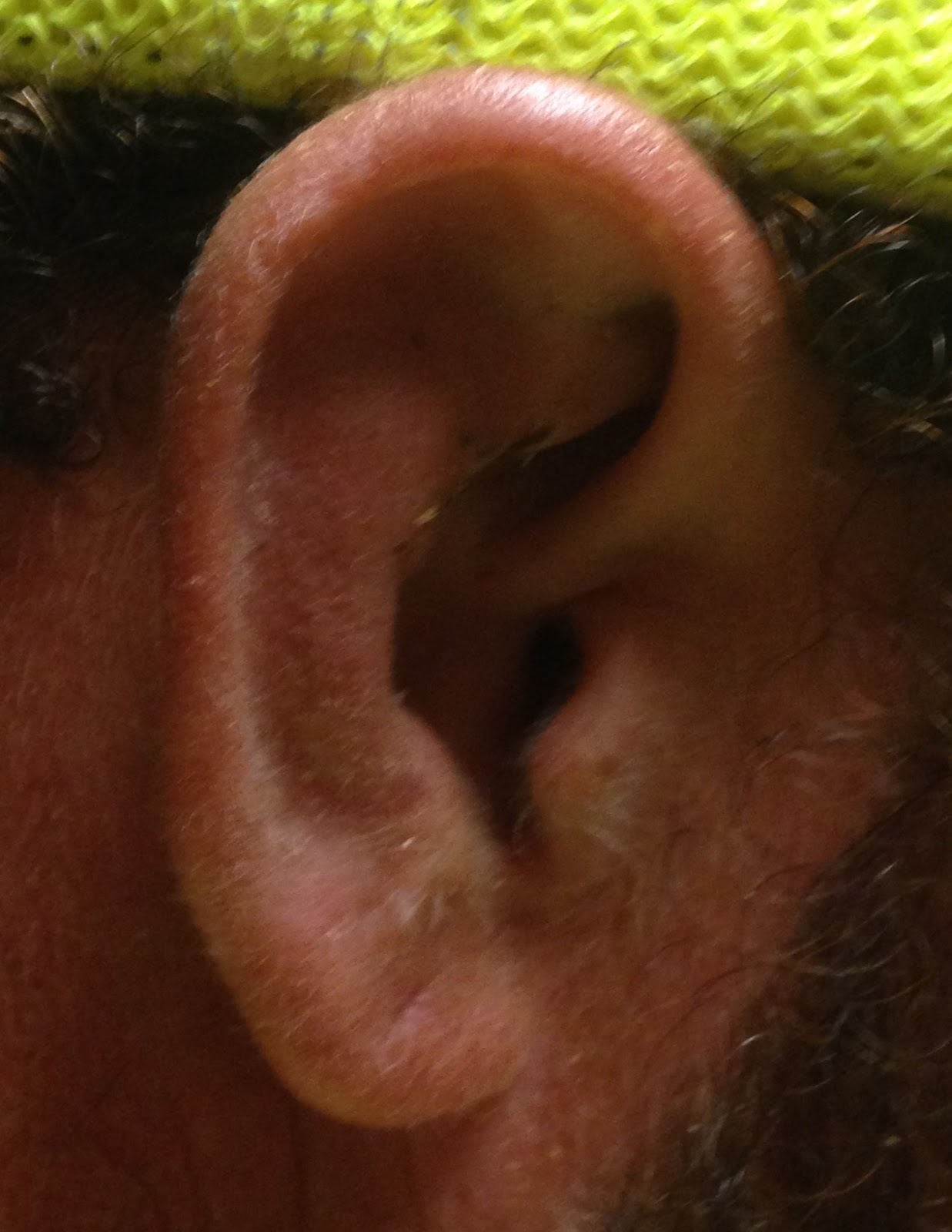 “Cauliflower” Ear or Auricular Hematoma