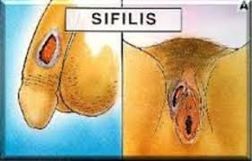 Obat Herbal Sipilis Ampuh Gambar%2Bsipilis%2Bpria%2Bdan%2Bwanita