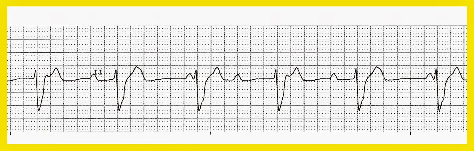 Ecg Examples Of Heart Blocks