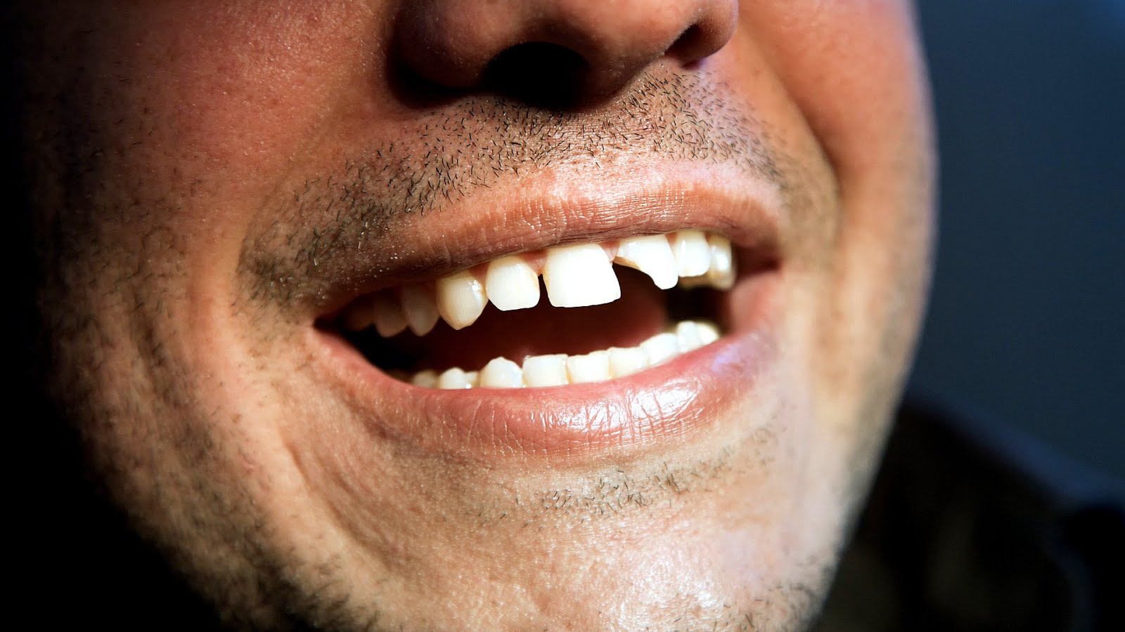 How Much Does A White Filling Cost White Choices