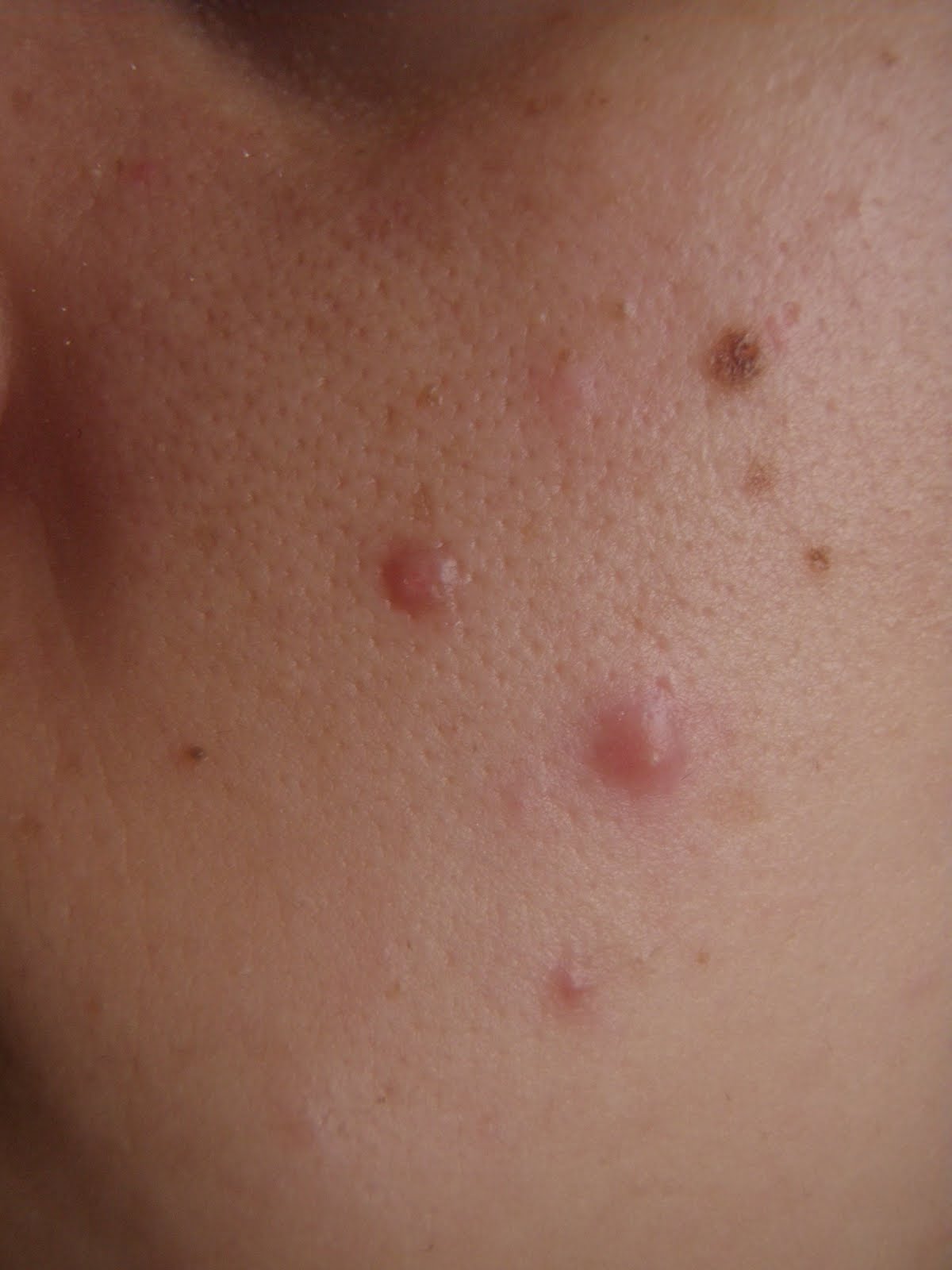 Niki Chennell Home Remedy to reduce pimple size