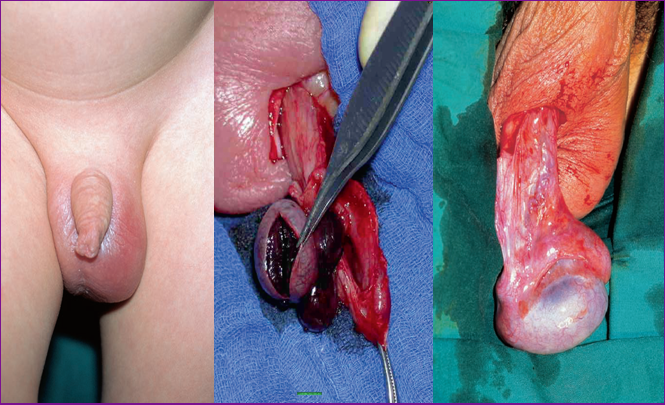 TORSION TESTIS- Scrotal Swellings 