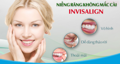 Ưu điểm của phương pháp niềng răng Invisalign