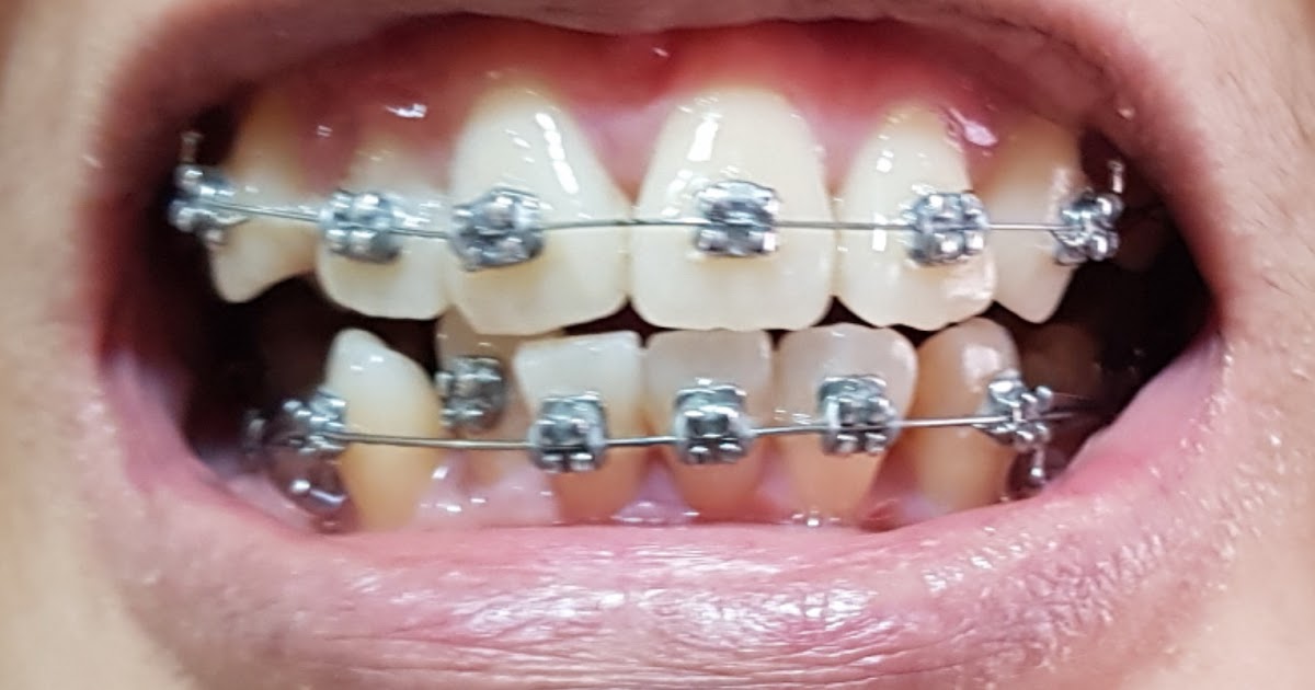 nanyfadhly Braces Story Updated! Part 4