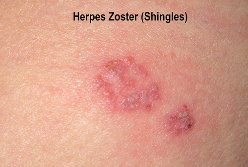Pictures of Viral Skin Diseases and Problems - Herpes Zoster