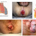 Benjolan di anus saat hamil
