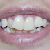 Niềng răng cửa mất bao lâu khi áp dụng cho các 2 hàm?
