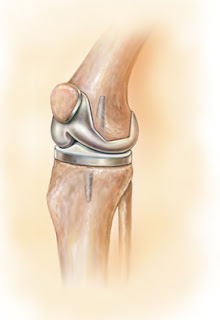 Rheumatoid Arthritis (RA) Causes and Symptoms