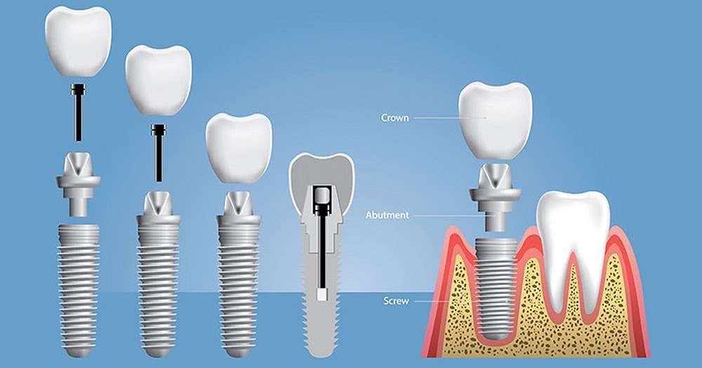 Dental Implant Procedure Step by step Directorio Odontológico