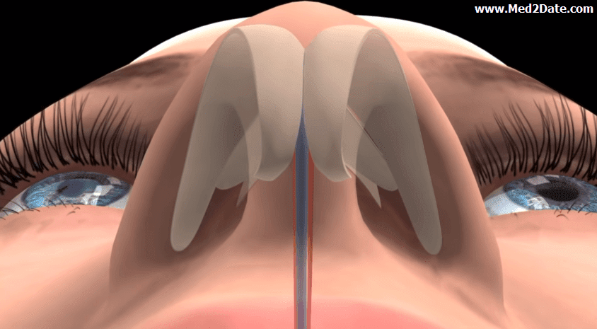 Гребень перегородки. Анатомия искривлённой носовой перегородки. Септопластика анатомия. Смещенная носовая перегородка. Искривление носового хряща.