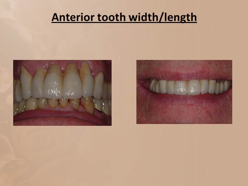 DOs and DONTs in DENTISTRY 4 Critical Aspects Of Anterior Dental Morphology we neglect