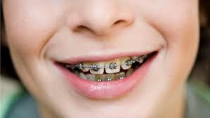Hai loại niềng răng kim loại bạn nên biết Hhhf%25C4%2591