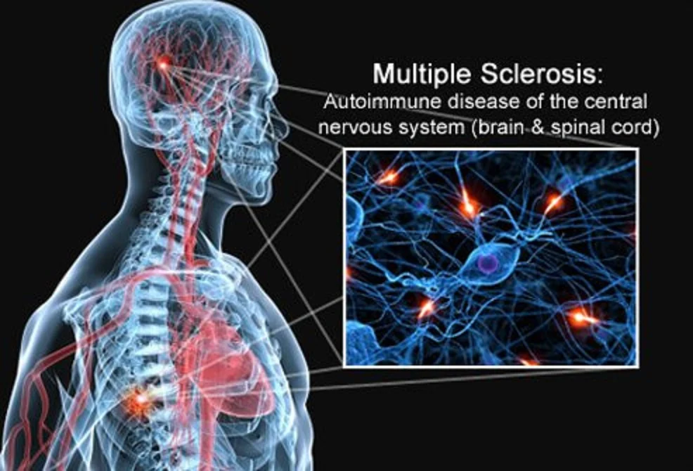 7 fatos sobre a esclerose múltipla que você deve saber