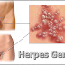 Obat Herpes Genital