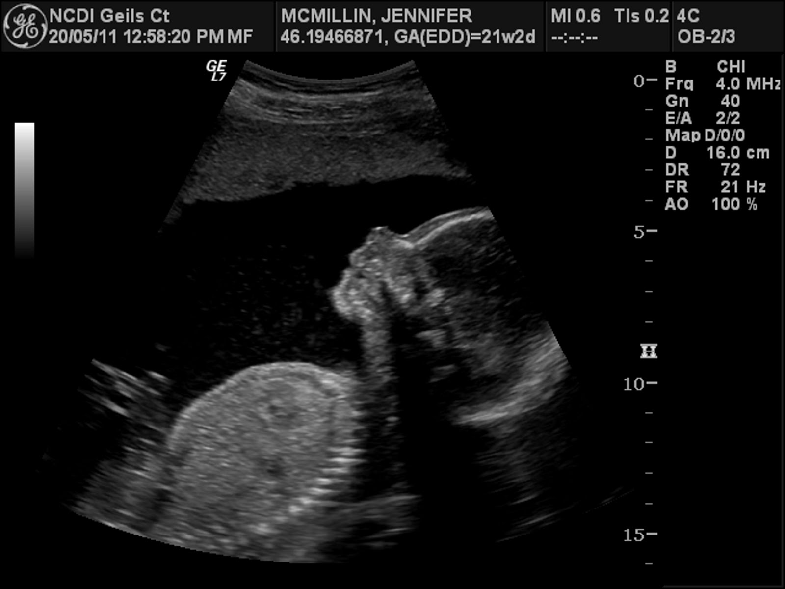 Adventures Down Under Baby 2 Ultrasound at 21 Weeks