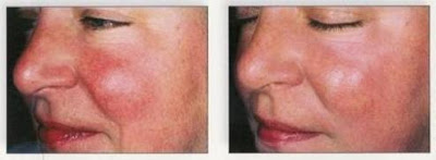 , ROSACEA CARE IN THE HEAT OF SUMMER