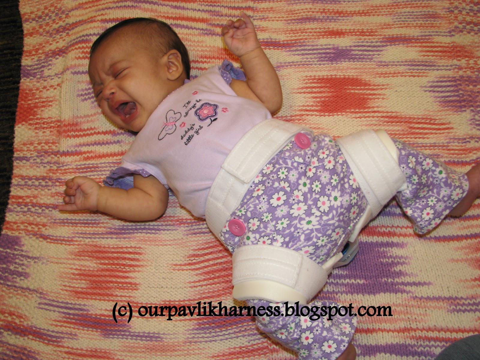 Our Pavlik Harness and journey with Hip Dysplasia CAST