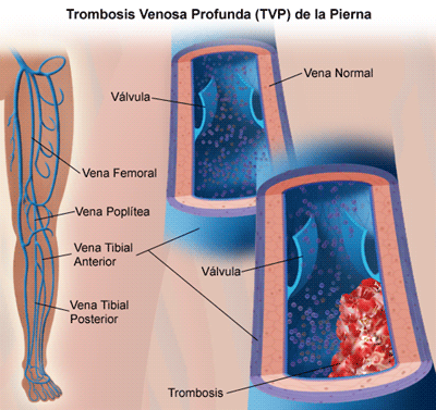 Profilaxis embolia de pulmonar profunda venosa y trombosis