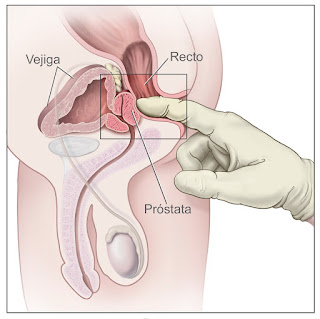 PSA Prostata