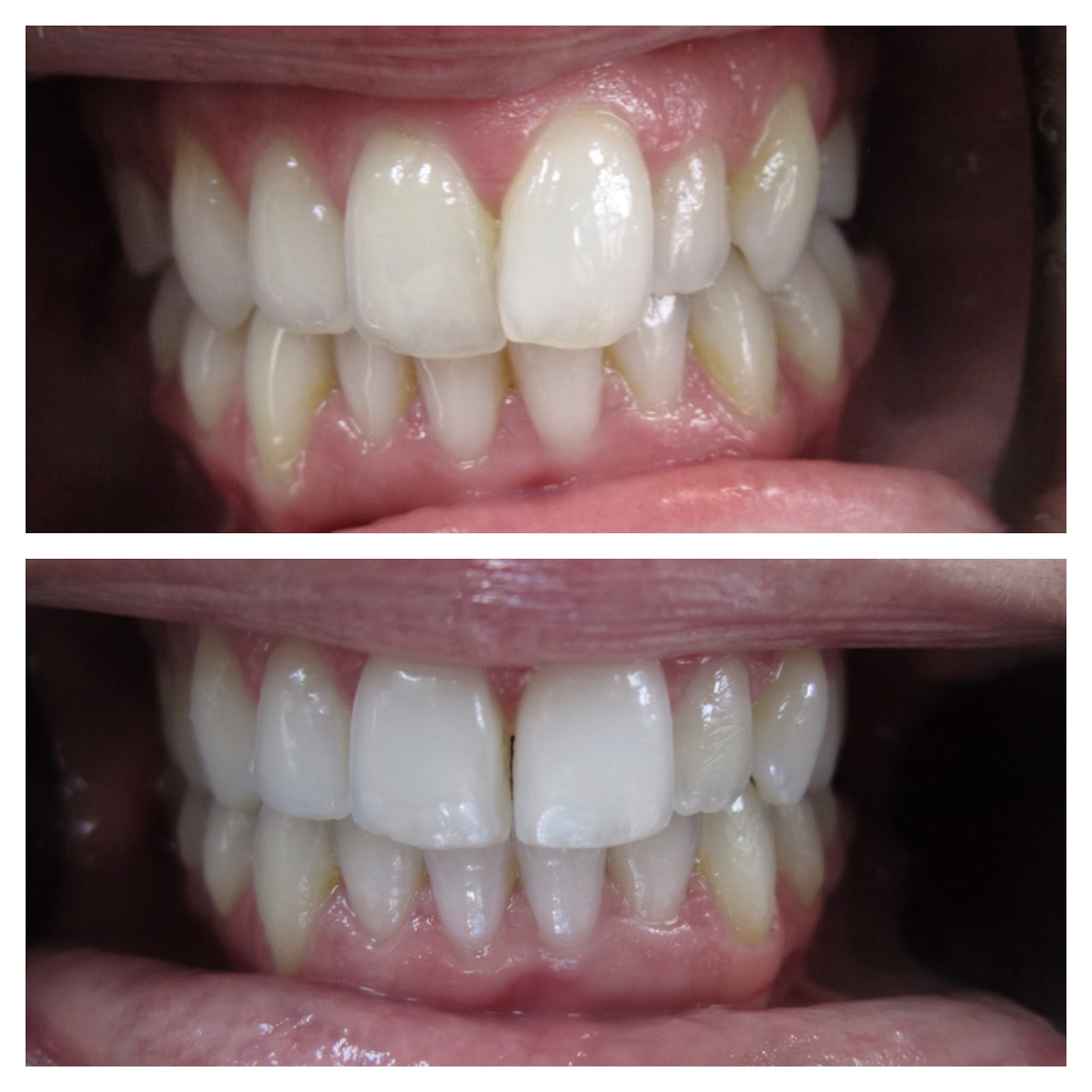 Alisha's Invisalign Blog - my journey from start to finish!