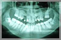 Todo lo que debes saber sobre los implantes dentales 6